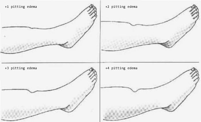 Edema Chart