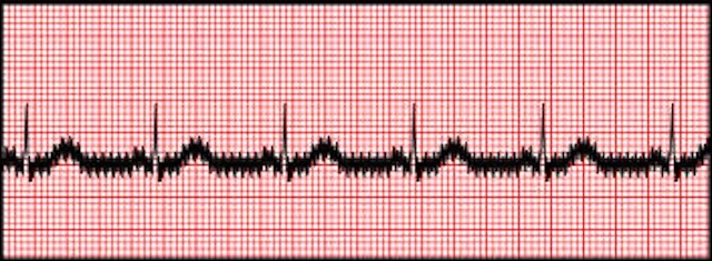 what-is-an-ekg-artifact-nursing-student-assistance-allnurses