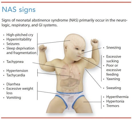 Treating Newborns in Opioid Withdrawal: A Nursing-First Approach ...