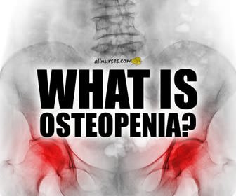 How To Manage Osteopenia and Strengthen Bones