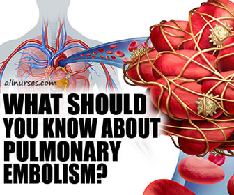 Pulmonary Embolism | Knowledge is Power
