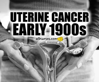 Uterine Cancer in the Early 1900s: An Era Gone By